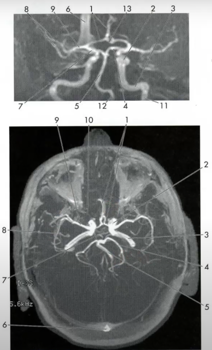 MR Angiography.