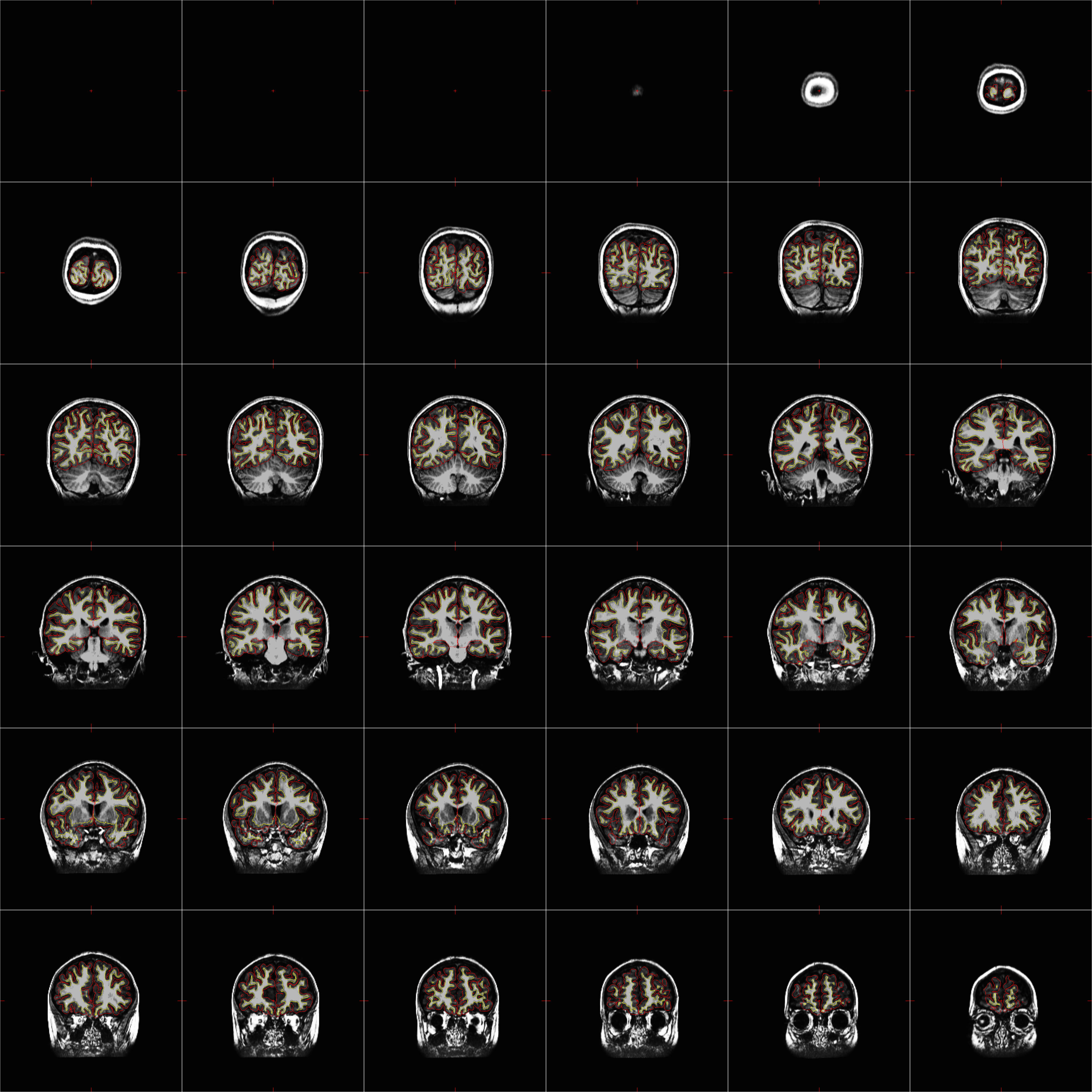 sub-ACAP1001_ses-BL_wm