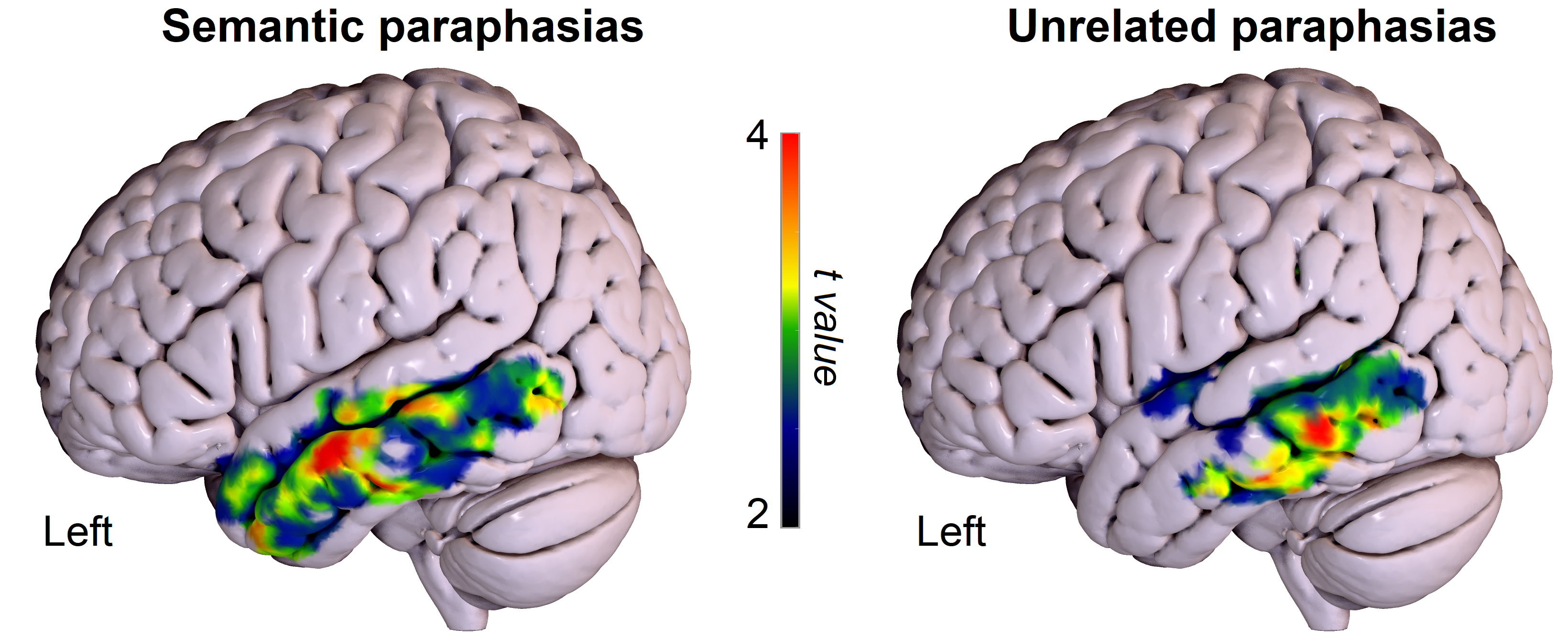 VLSM results for semantic (left) and unrelated (right) paraphasias. The colours indicate the strength of the associations. Only the left hemisphere is shown. This figure is a courtesy of Brielle Stark.